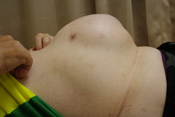 hernia1.webp