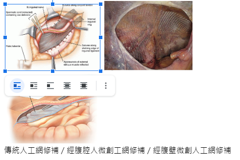 hernia2.webp