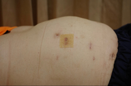 hernia3.webp