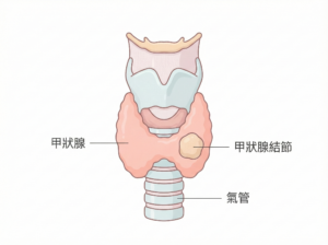 thyroid nodule.webp
