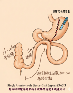 雙通道縮胃繞道